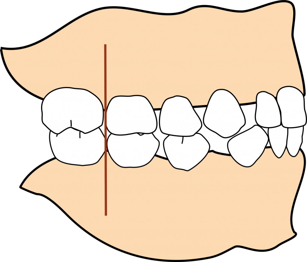 Classification of occlusion DentalPANDA