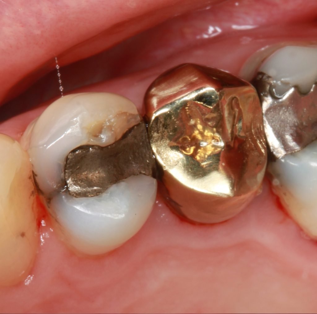 Dental Caries 10 Cracked tooth 1 1024x1016 1