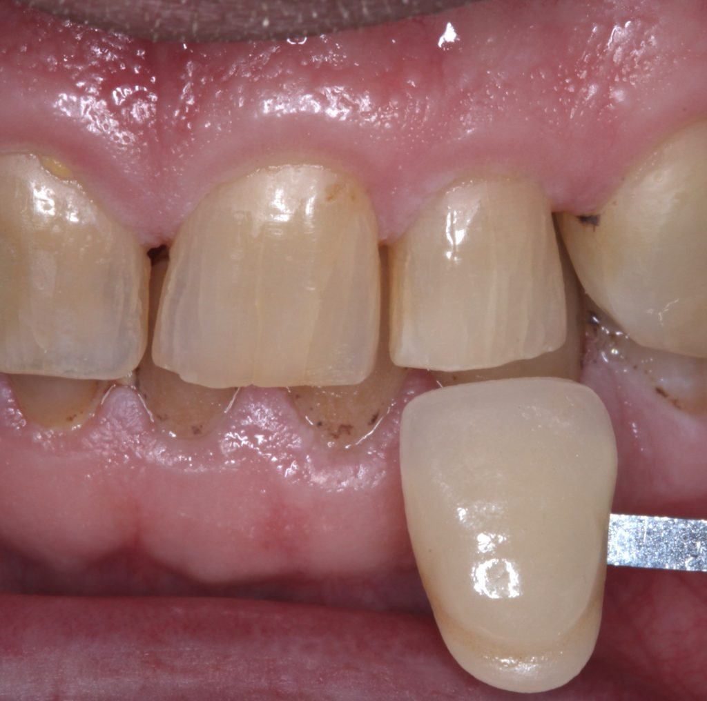 Dental Caries 11 Cracked tooth 2 1024x1016 1