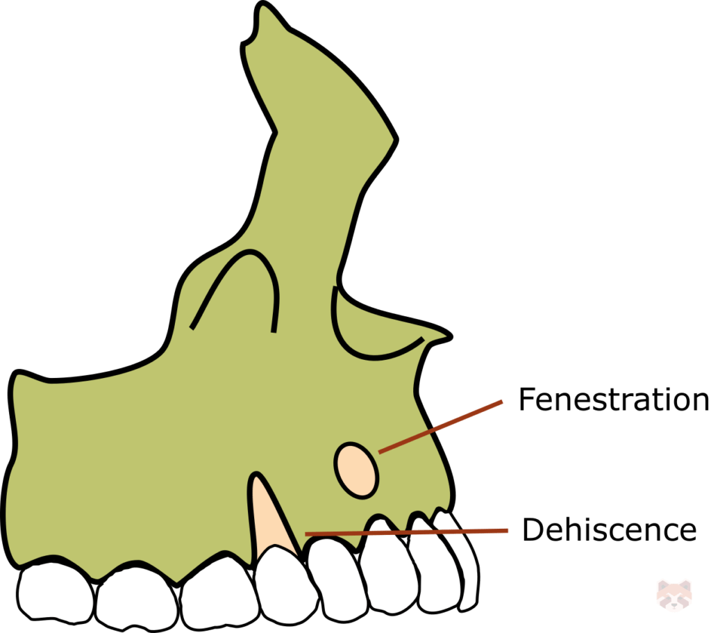 Clinical Assessment 2 Dehiscence 1024x911 1