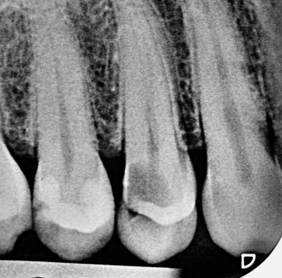 Dental Caries 5 Distal caries