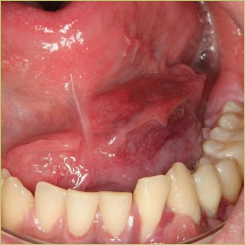 Non-odontogenic tumors 9 Ewings Sarcoma1 1024x1024 1