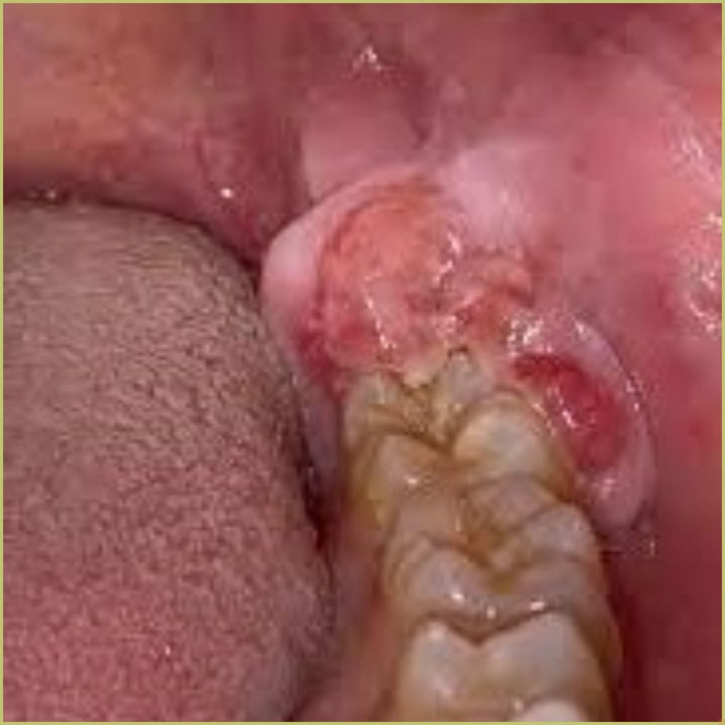 Non-odontogenic tumors 11 Ewings Sarcoma3 1024x1024 1