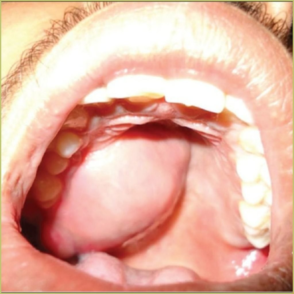 Non-odontogenic tumors 12 Ewings Sarcoma4 1024x1024 1