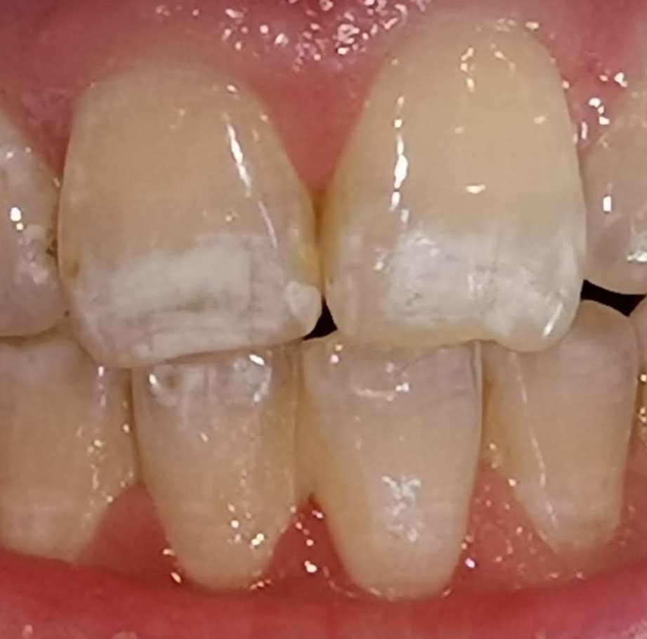 Dental Caries 6 Hypomin