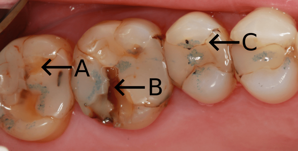 Dental Caries 13 Marginal leakage and caries 1024x518 1