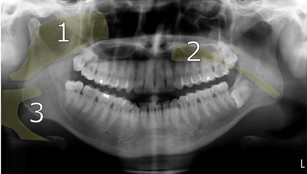 Radiography and Radiology 8 OPG 2 1 1024x580 1