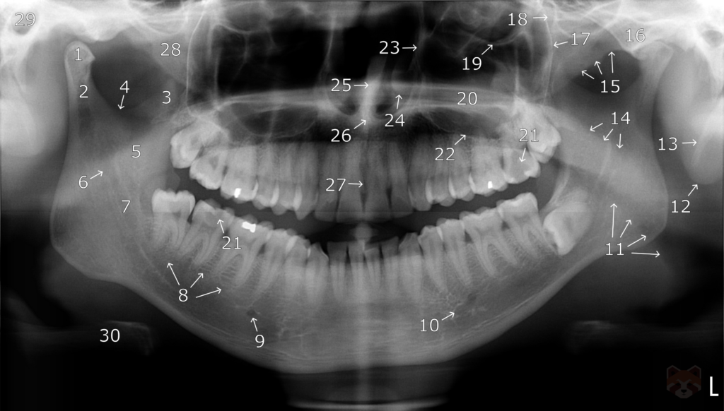 Radiography and Radiology 7 OPG1 1 1024x582 1