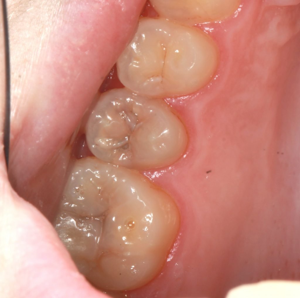Dental Caries 3 Occlusal caries 1 1 1024x1016 1