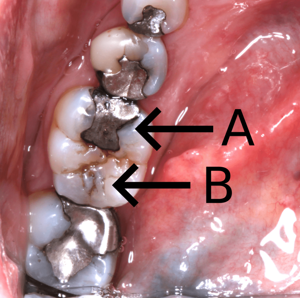 Dental Caries 4 Occlusal caries 2 1024x1016 1