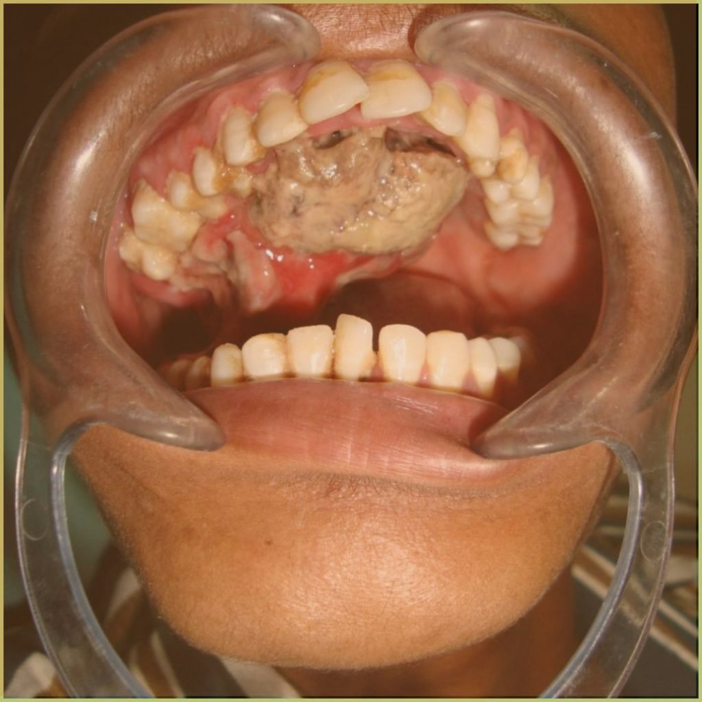 Non-odontogenic tumors 13 Osteosarcoma 1 1024x1024 1