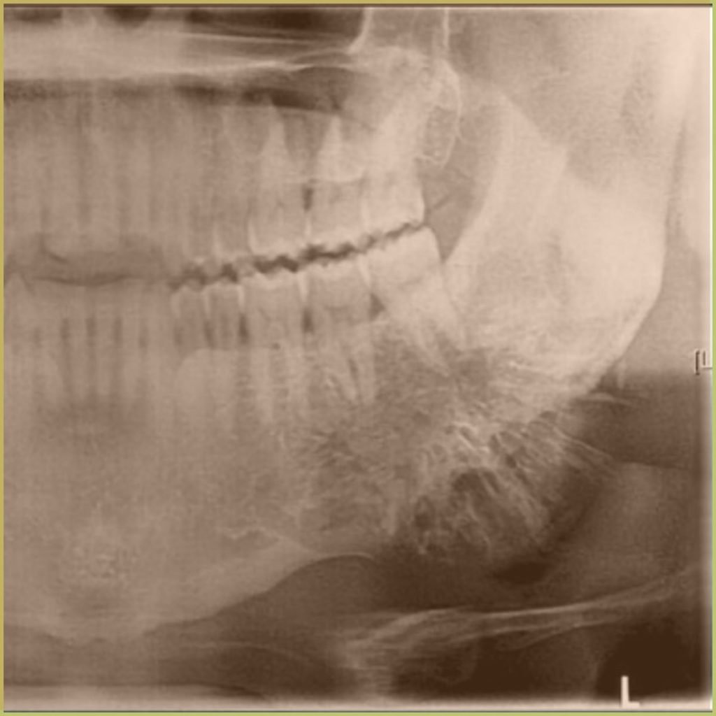 Non-odontogenic tumors 15 Osteosarcoma 3 1024x1024 1