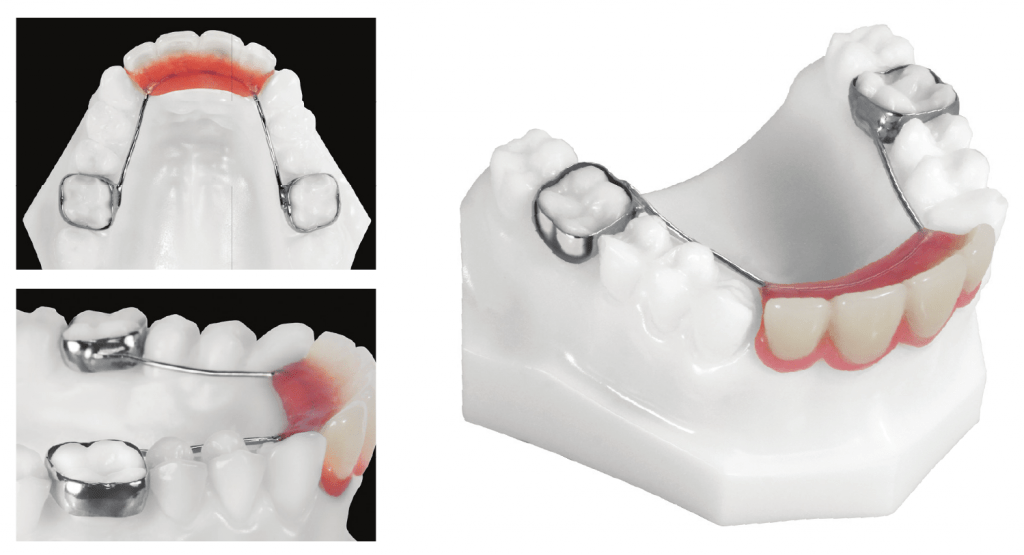 Advanced Orthodontic Treatment and Retention 5 Pedo partial 1024x555 1