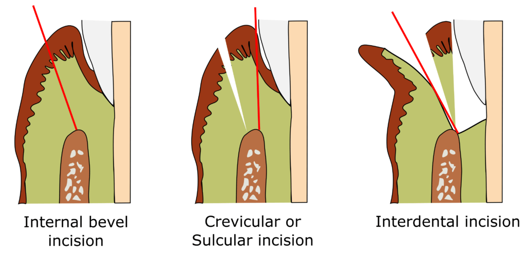 Surgical Periodontal Treatment 1 Periodontal incisions 2 3 1024x497 1