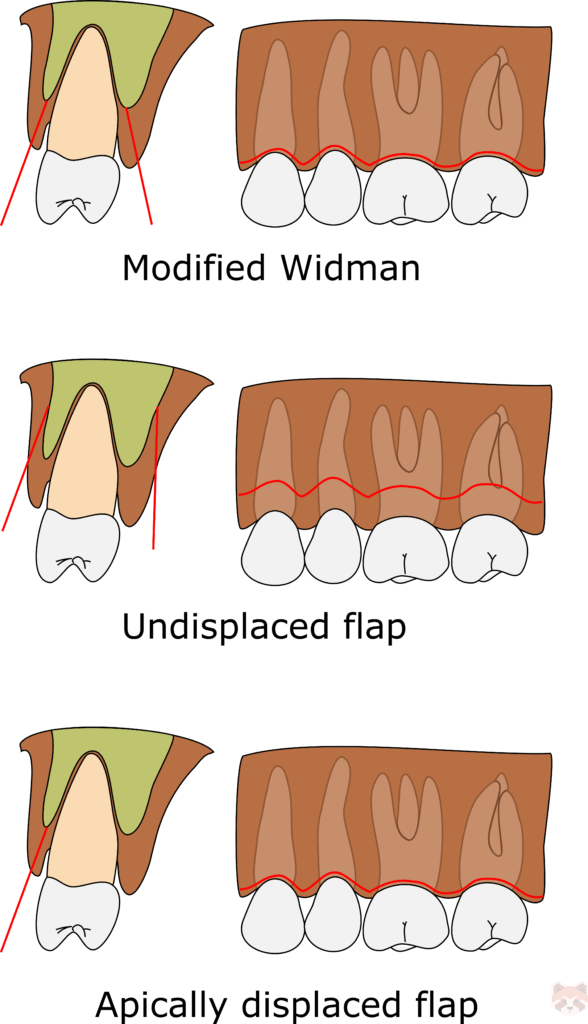 Surgical Periodontal Treatment 2 Periodontal incisions 3 588x1024 1