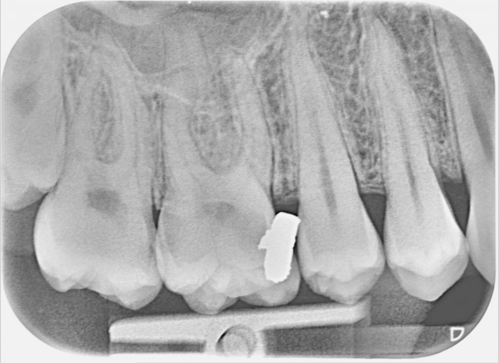 Dental Caries 12 R Slade PA16 Copy 1024x745 1