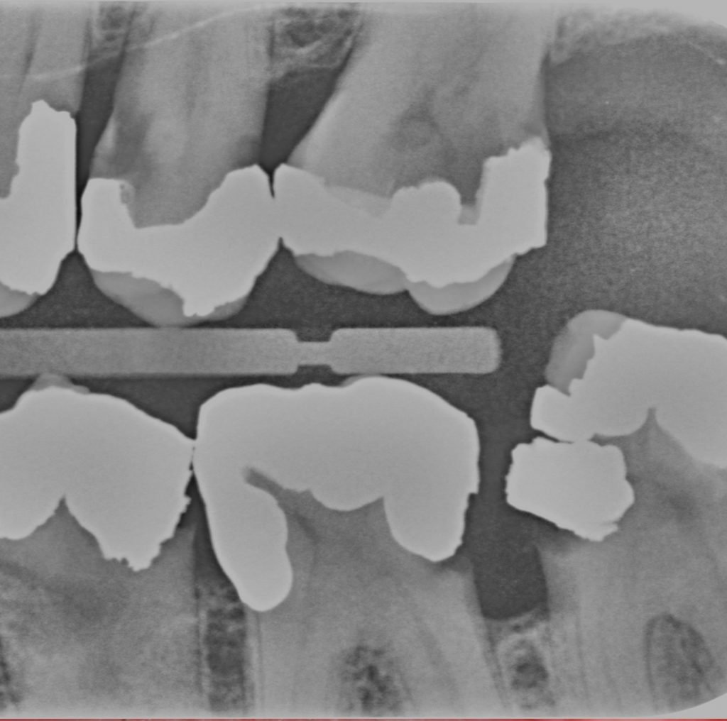 Dental Caries 8 Root surface caries cropped 2 1024x1016 1